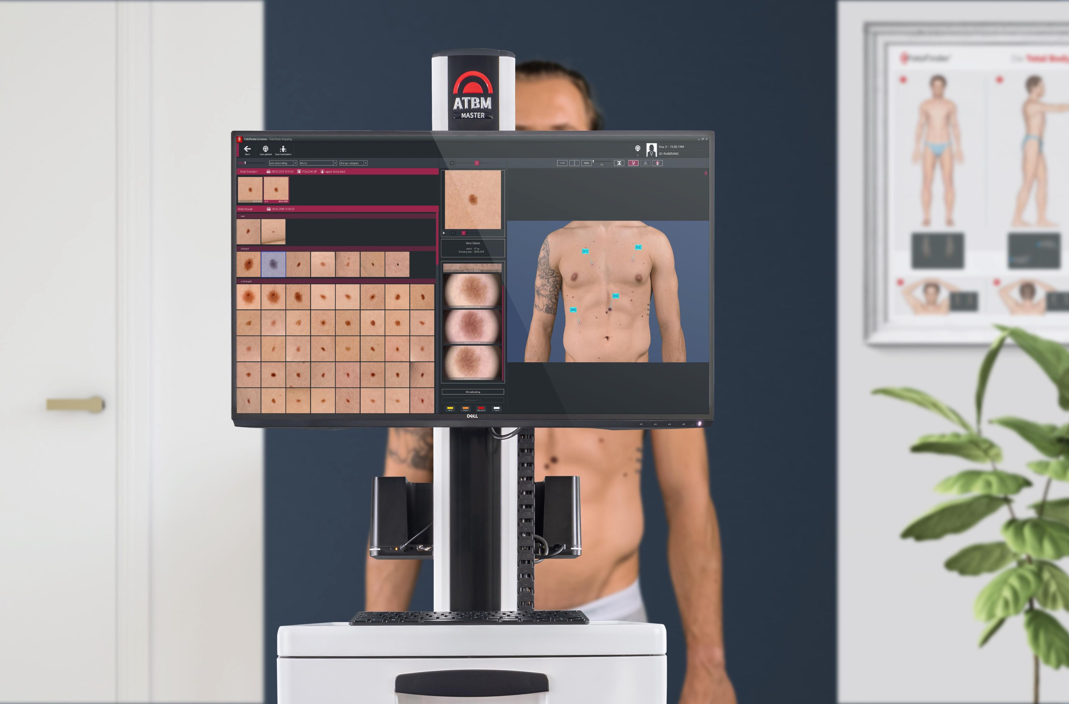 Automatisches Total Body Mapping mit dem FotoFinder System